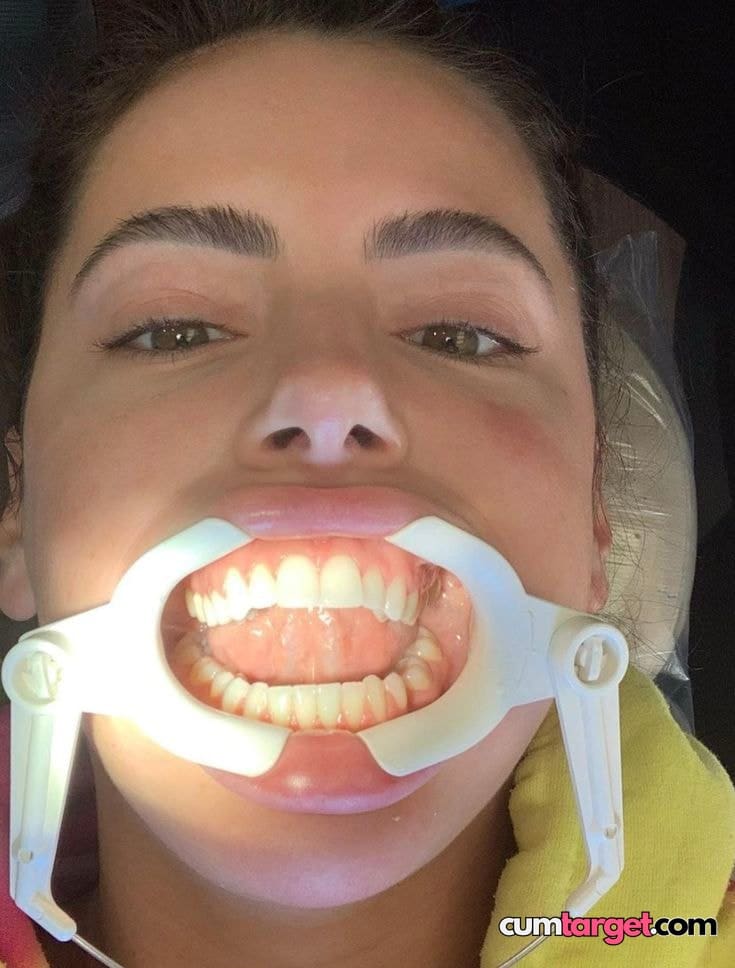 Wait for you Dental Mouth Opener Used
