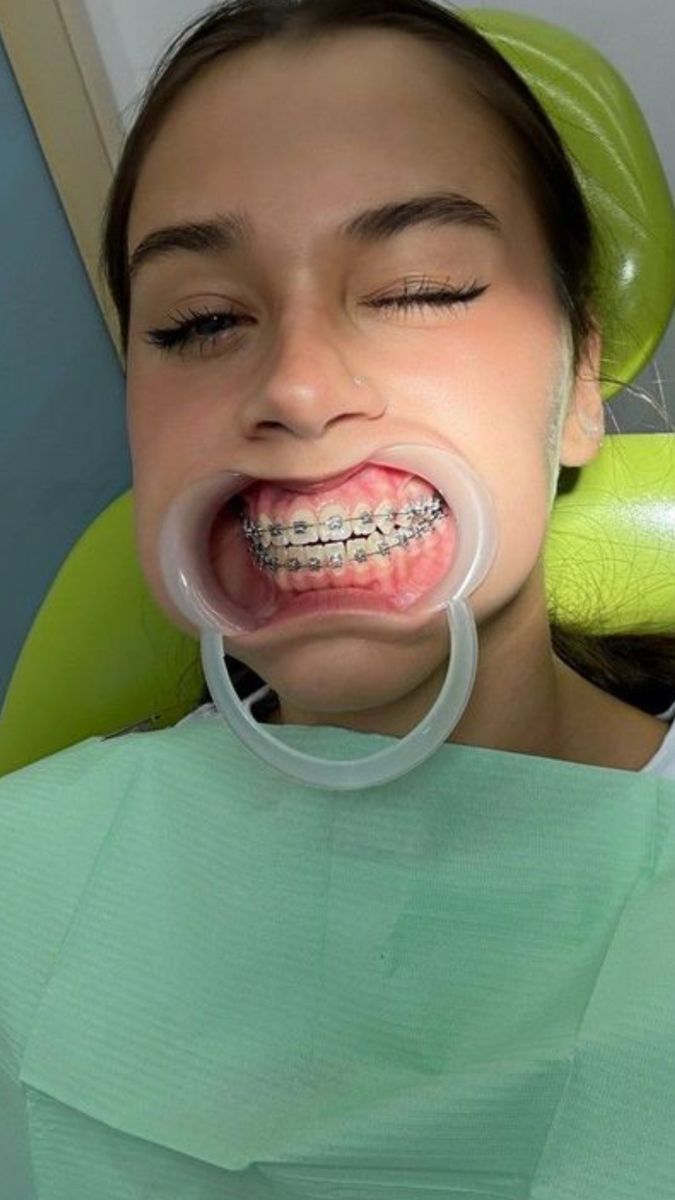 Dental Brace Checkup