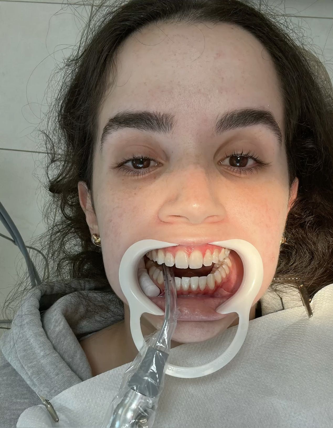 Dental Checkup with Mouth Opener