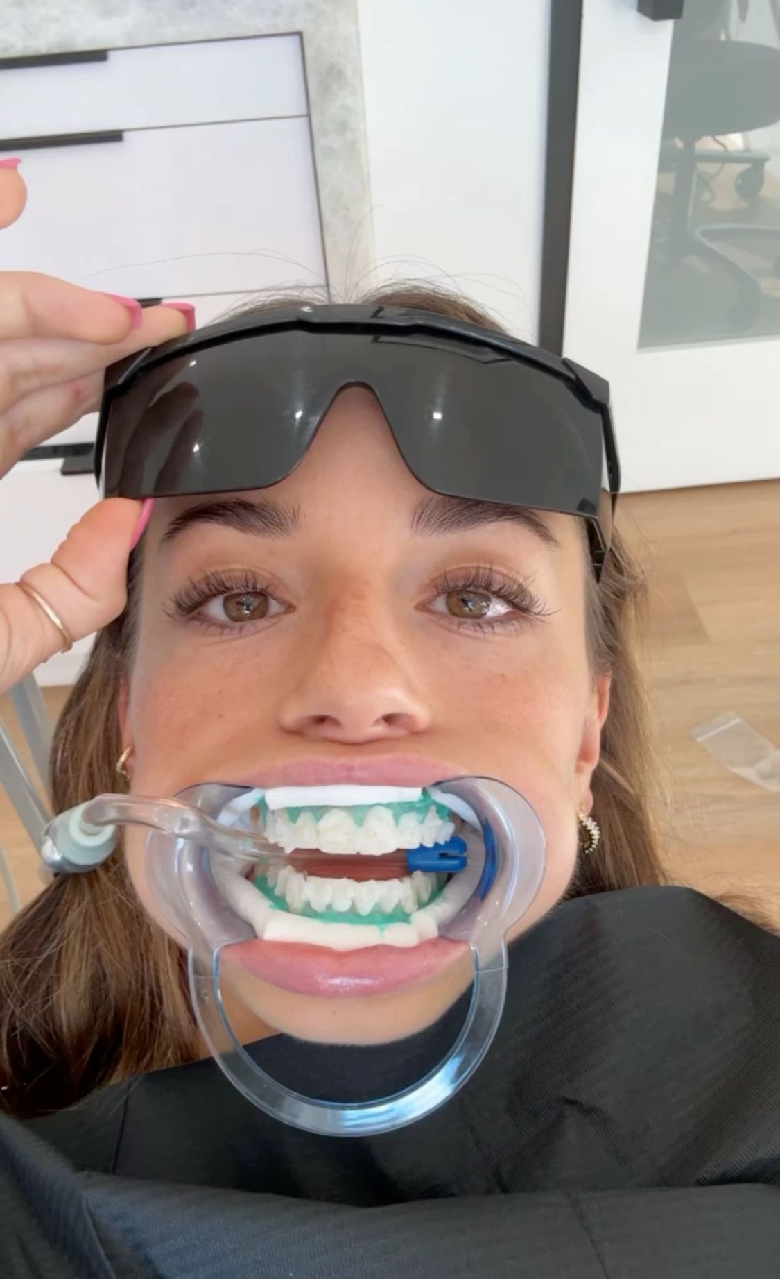 Dental Whitening Procedure