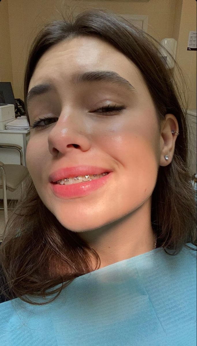 Close-up Smile with Braces