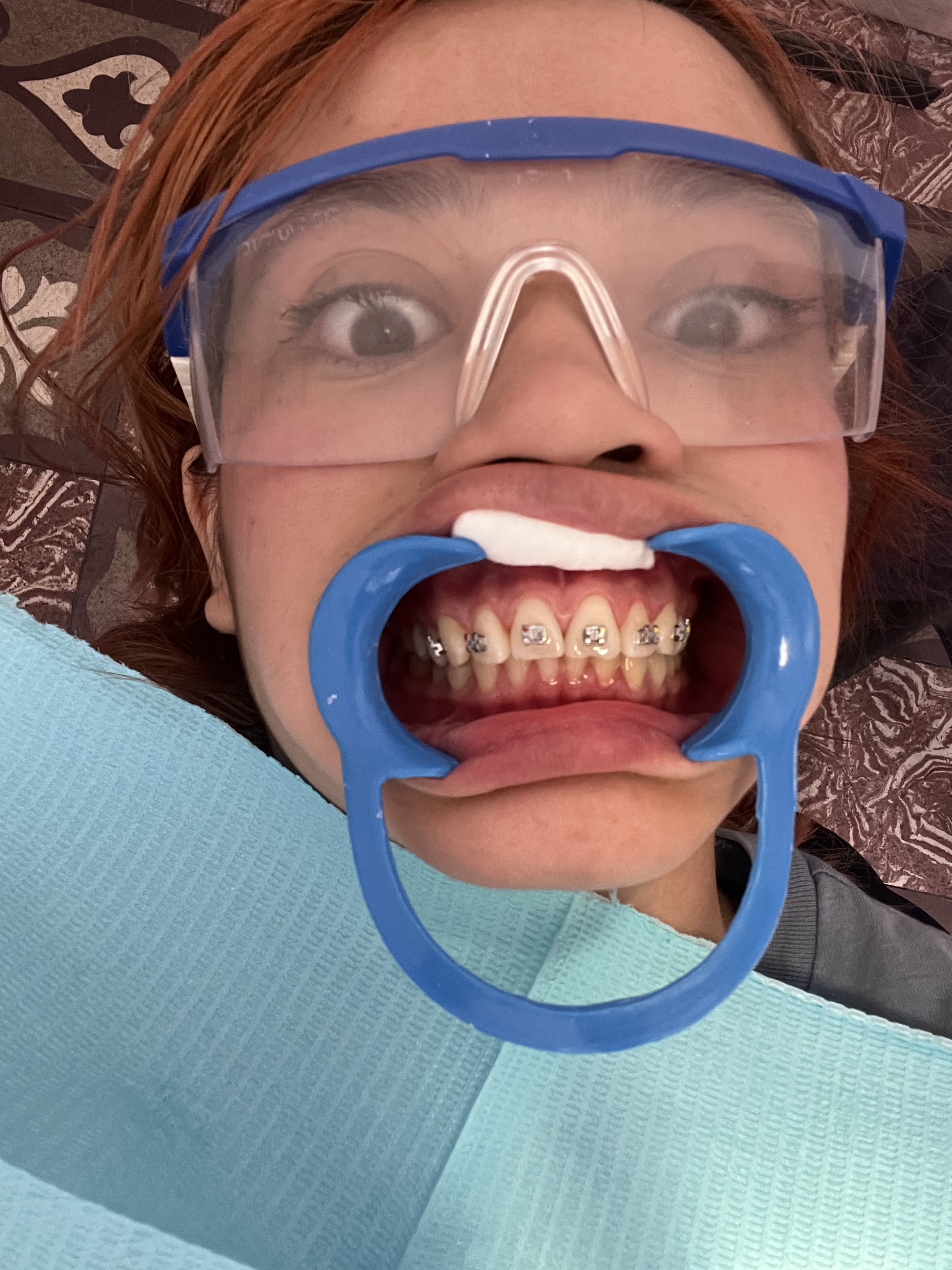 Dental Check with Mouth Opener