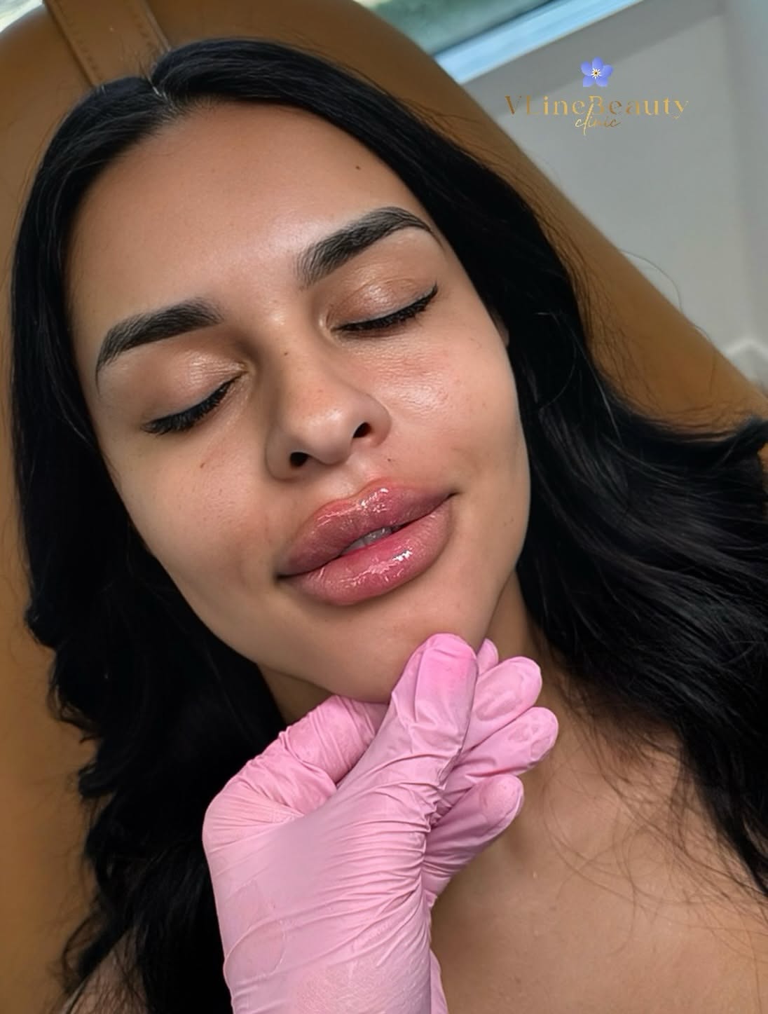 Lip Enhancement Procedure