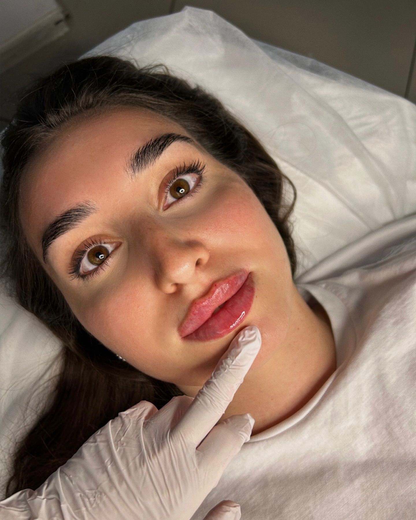 Lip Enhancement Procedure