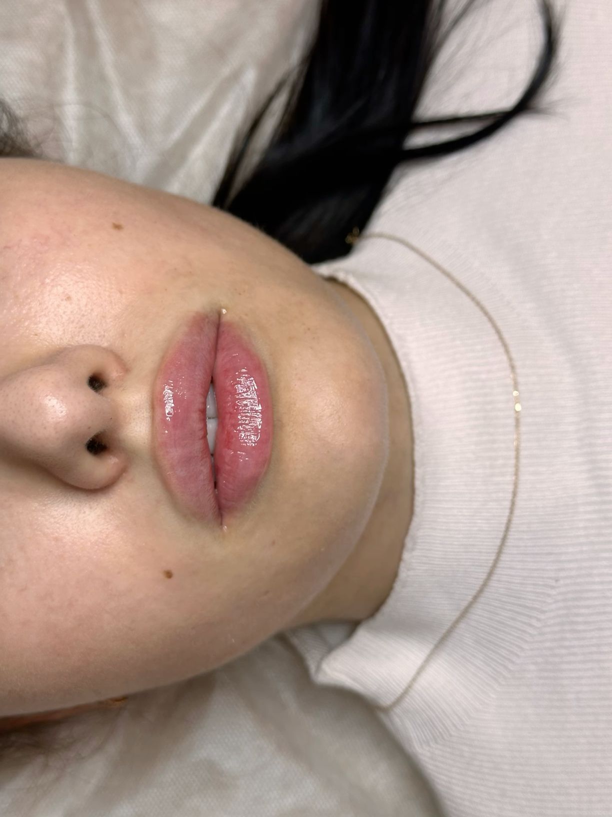 Cosmetic Lip Enhancement Close-up